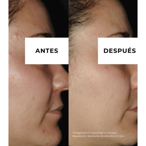 Arganour - Crema antiacne riducente per le macchie  Equilibrium - Pelle grassa a tendenza acneica