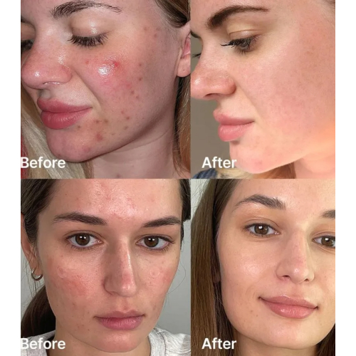 Medicube - *Red* - Siero Red Succinic Acid Clarifying