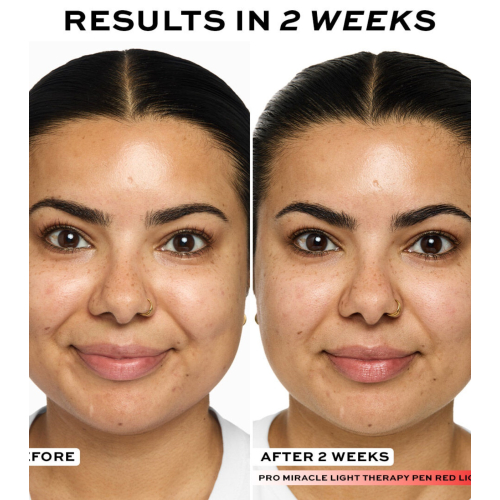 Revolution Pro - Dispositivo per fototerapia a LED Pro Miracle