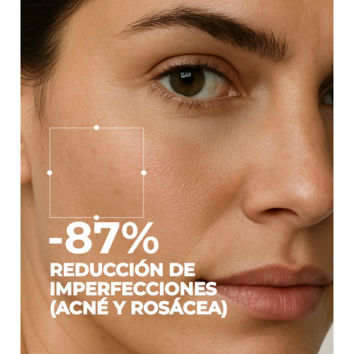 SEGLE - Kit per il trattamento anti-acne e rosacea