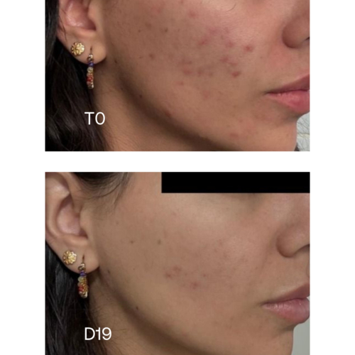 Sensilis - *Oily Skin* - Concentrato anti-imperfezioni Pure 15AZ